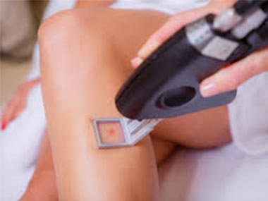 Image of laser vein removal