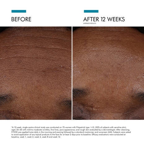 p-tiox-before-after-forehead-lines-12-weeks